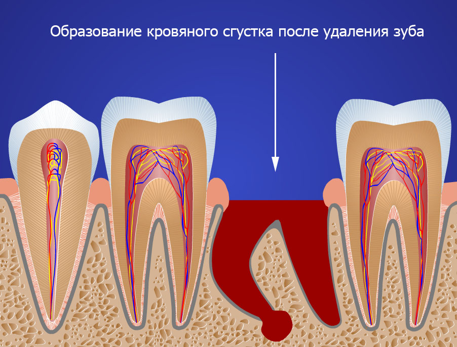 Как остановить кровотечение после удаления зуба? - на портале ремонты-бмв.рф