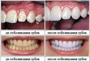 Как отбелить зубы содой